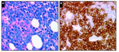T-cell lymphoma: immunophenotype Nodal PTCL - immunophenotype Complex!