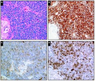 Myeloid sarcoma: testis Myeloid sarcoma: testis CD33 Rituximab (anti-cd20) B-cell