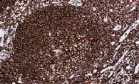 IHC Dogma Diagnostic Applications of IHC 1 (also applies in diagnostic haematopathology) IHC complements routine staining Helps characterise cells and architecture No single antibody is disease