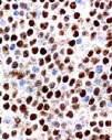 B-cell Small Lymphocytic Lymphoma (CLL) Morphology small lymphocytes proliferation centres Mantle Cell Lymphoma Morphology small-medium medium lymphocytes cleaved /