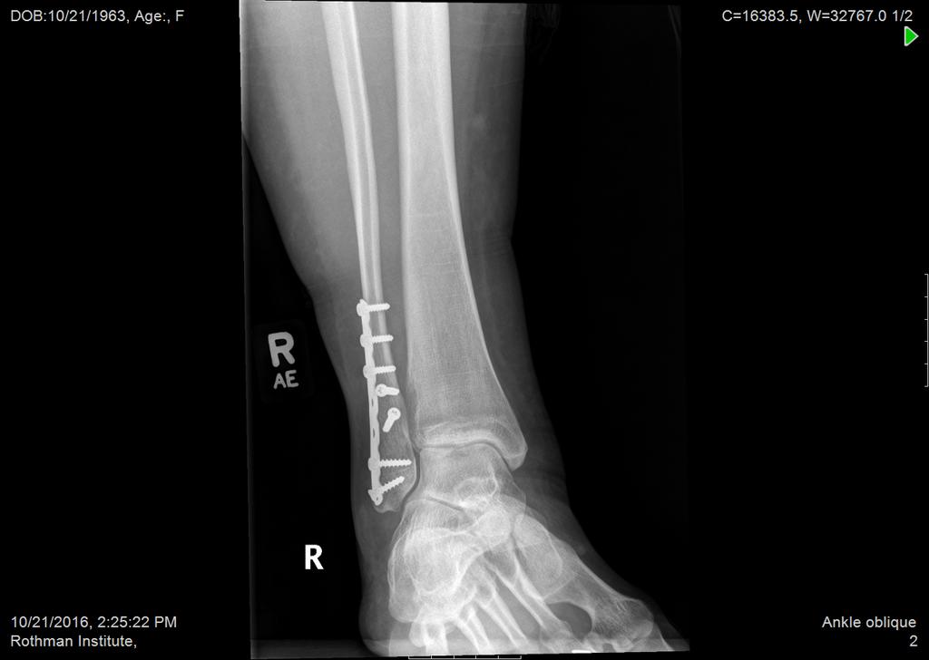 Methods Clinical healing walking comfortably, minimally tender on palpation, and evidence of radiographic healing Radiographic healing blinded review by 2 fellowship-trained foot