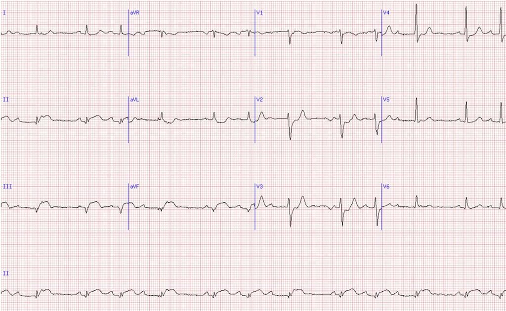 Case 1: Rhythm Rhythm is irregular but Are there p waves? Yes Are the p waves upright in lead II?