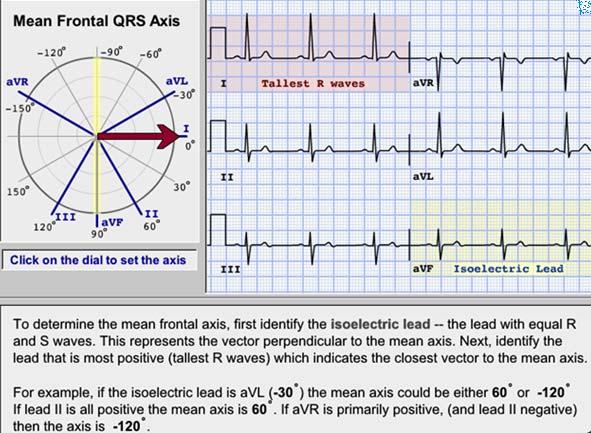 QRS Axis