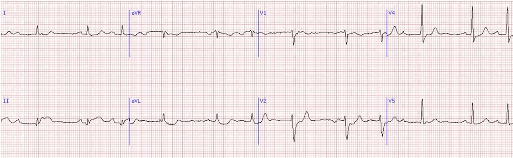 Case 1: QRS Axis Let s determine the QRS Axis.
