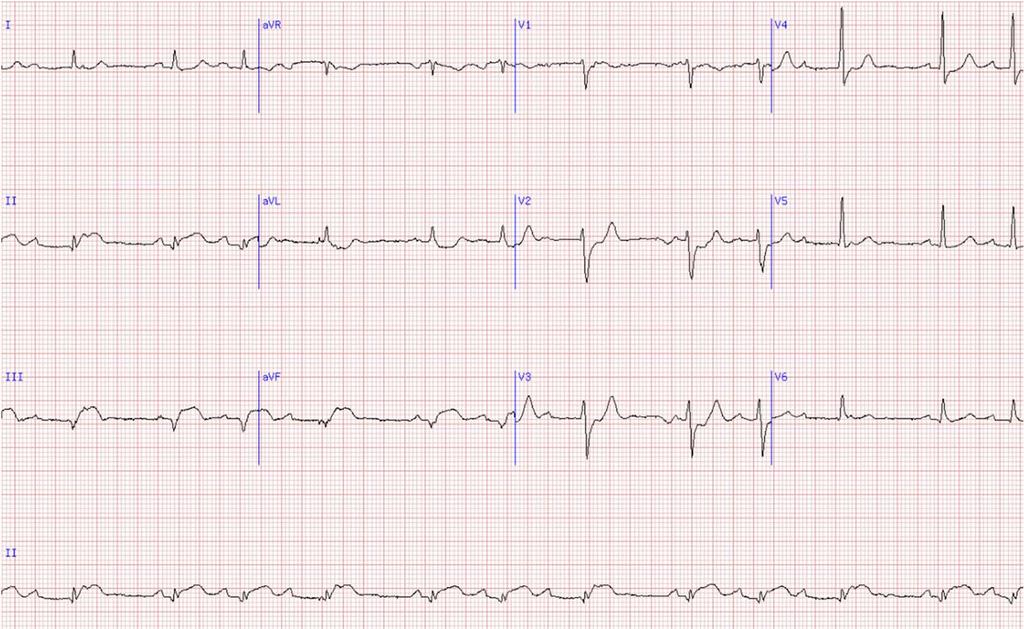 Case 1: Intervals QRS duration: How many boxes is the