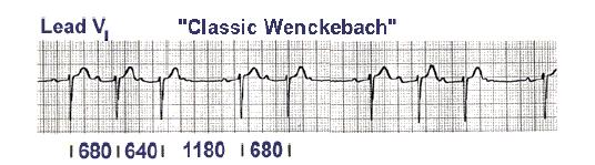 Atrioventricular Blocks 2 nd Degree AV Block Type 1 (Wenckebach) In classic Wenkebach, the PR interval gets longer until a nonconducted P wave occurs.