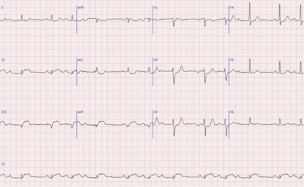 Case 1 summary EKG interpretation at this point Rate = 70 and irregular Rhythm = atrial is regular at < 100 bpm, narrow complex with positive p wave in lead II, c/w sinus rhythm With Wenckebach QRS