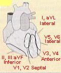 Reciprocal Changes Acute anteroseptal infarctions (V1, V2, V3) may show reciprocal lateral changes in