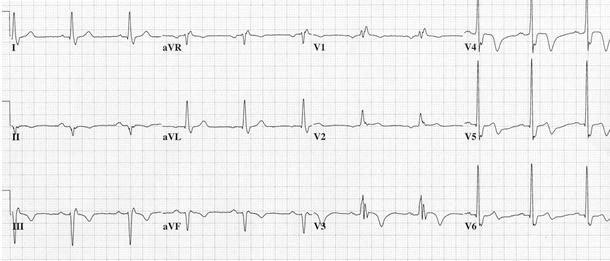 Wellens syndrome or LAD coronary T-wave syndrome.