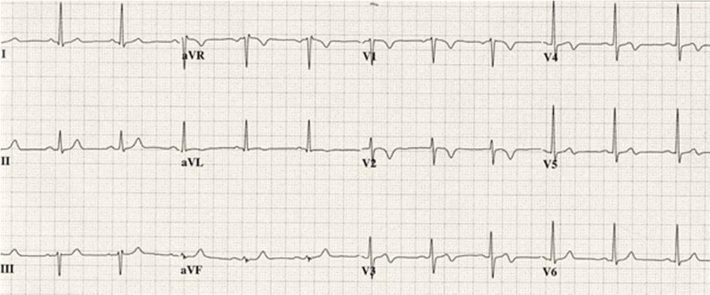 biphasic T waves, most commonly in leads
