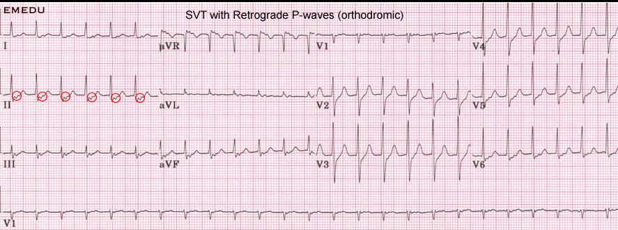 Case 3: AV Nodal Re-entrant Tachycardia No definite p waves seen before the QRS, rate ~ 150 to 200 and very