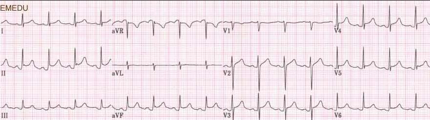 Case 4: 42 year old male with sharp substernal chest pain What is your diagnosis