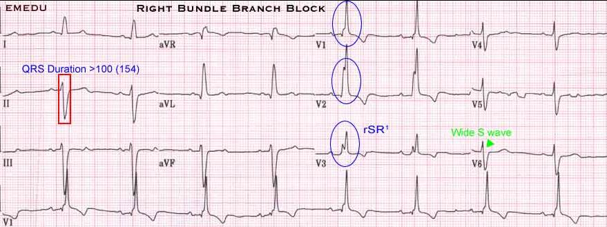 Right Bundle Branch Block 120 ms Complete RBBB has a widened QRS > 0.