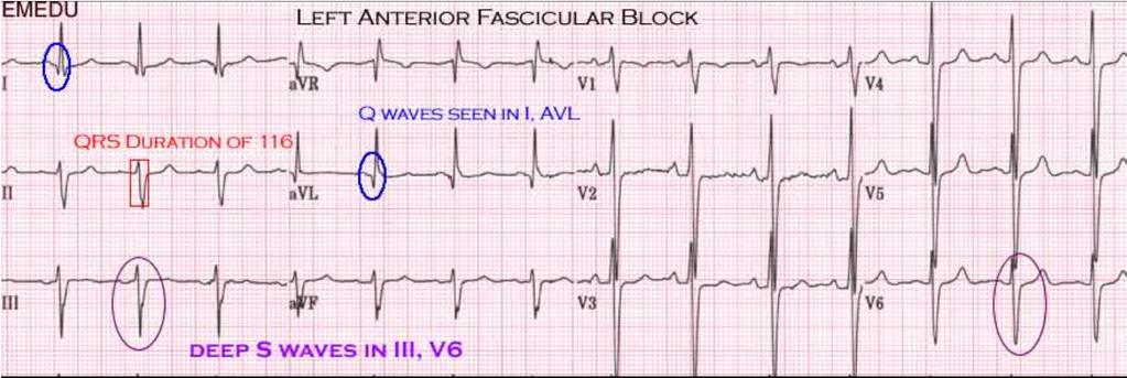 Left Anterior Fascicular Block When isolated LAFB, QRS duration < 0.