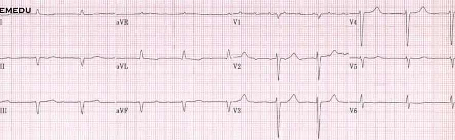 Case 6: 68 y.o. w/ dyspnea. Let s interpret the EKG. 0 1 2 3 4 5 6 Rate 60 & irregular Rhythm? QRS 110 ms QTc 430 ms PR?