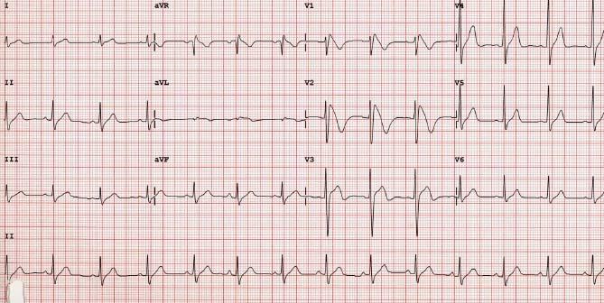 Case 8: 41 y.o. has been intermittently feeling very lightheaded. Does anything appear unusual on this EKG?