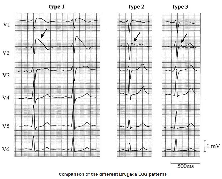 Case 8: Brugada Syndrome recognized in 1988 and described in 1992 is a genetic sodium channel defect that leads to V fib. Worsened by Class 1C antiarrhythmics (i.e., flecanide) and vagal maneuvers