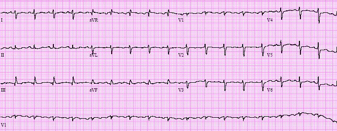 Case 10: This patient is new to your practice and sends ahead his records which include this EKG that s not interpreted. S > R wave in I & AVL No RVH Small Q in II, III, AVF Axis ~ +120 QRS <0.