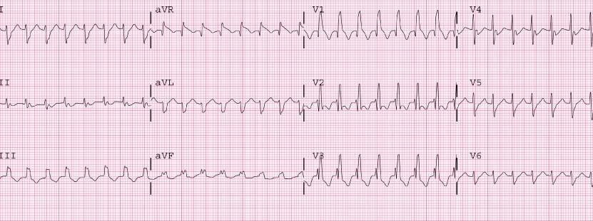 Case 11: 51 year old female feels palpitations and lightheadedness. Rate = 180 bpm QRS = 0.15 sec Rhythm =? Is this rhythm an aberrantly conducted SVT or ventricular tachycardia?