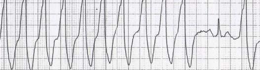 Case 11: Wide Complex Tachycardia EKG differentiation of VT from SVT with aberrancy is not always possible, some features favoring VT include: AV dissociation (identify P and