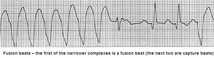the onset of the QRS complex to the nadir of the S wave is