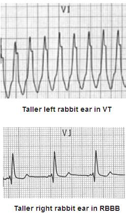RSr complexes with a taller left rabbit ear strongly favor of VT In