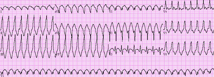 Is this V-tach or SVT with aberrancy? Brugada criteria: Is there absence of RS complex in all V1-V6 leads? If Yes, V-tach.