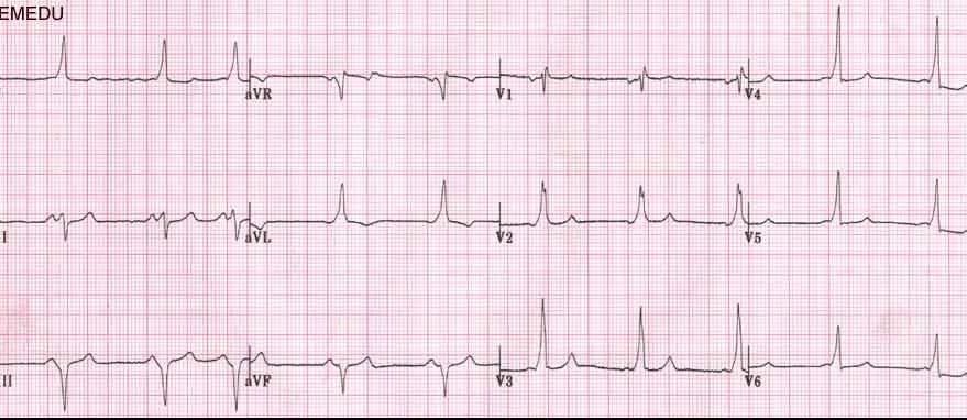 Case 13: 19 year old with intermittent dizziness and palpitations Rate: 62 Rhythm: Sinus with PAC Axis: -45 (mechanical shift, LBBB,
