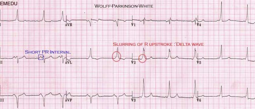 Case 13: Wolff-Parkinson-White Syndrome An absent or difficult to see negative delta wave in V1, and S > R in V1