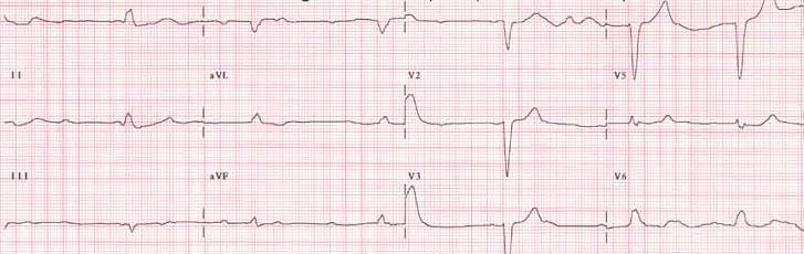 Case 14: What is the rhythm?