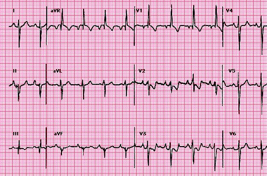 Case 15: Which two chambers are enlarged? Right Ventricle and Right Atrium Negative QRS in Lead 1 Positive QRS in Lead V1 Lead II p > 2.