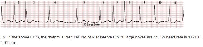 Rate with Irregular Rhythm For irregular rhythms, check the EKG s 3 second markers (15 large boxes).