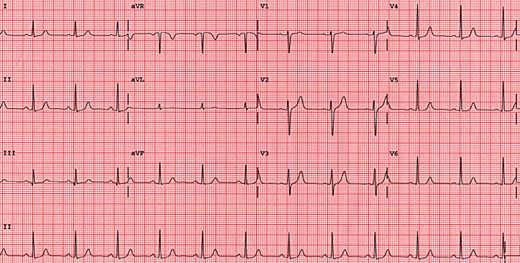 Rhythm and Rate Are there P waves? Are they regular? Does every one precede a QRS? Is the PR interval constant? What is the PR interval?