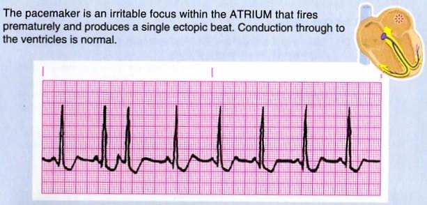 Premature atrial contraction acronym is PAC; sort of a misnomer as this is a premature atrial depolarization.