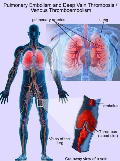 Background Venous thrombosis Yearly incidence 1/1000 person-years 1/3 of DVT complicate with a clot in the lungs Recurrence at 5 years