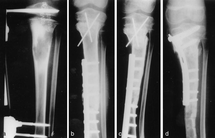Figure 2. Osteosarcoma in the proximal metaphysis of the tibia in a 5 year old child. Physeal distraction according to Cañadell's technique was used in order to preserve the joint.