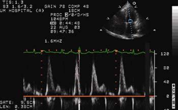 Restrictive Cardiomyopathy Restrictive MV filling Very Low e