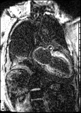 Late Gadolinium Enhancement Imaging Diffuse hyperenhancement of both ventricles Dark signal within cardiac chambers