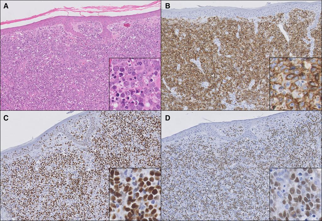 426 Arch Dermatol Res (2016) 308:423 427 Fig. 3 Histopathology of a patient with primary cutaneous diffuse large B-cell lymphoma, leg type.