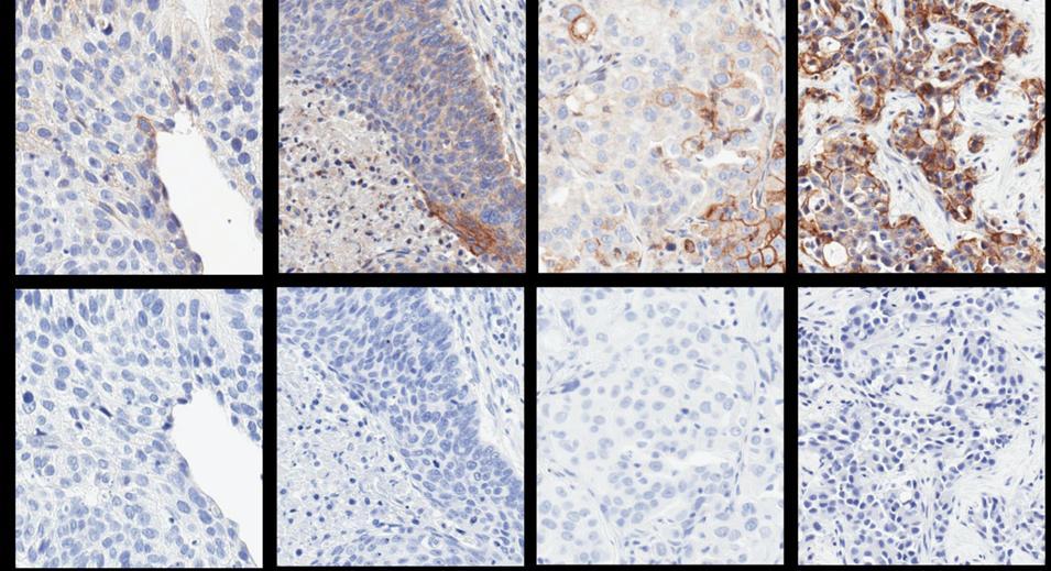 Checkmate-12 and -3 PD-L1 Expression in NSCLC Samples Non-Small Cell Lung Cancer % Staining 1% 5% 2% 65% Positive Negative Control Antibody PD-L1 expression NSCLC