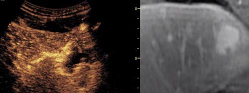 Case 1: Liver Hemangioma Fusion Fusion images of MRI abdomen with