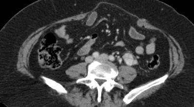 Case 4: Metastatic Disease Contrast-enhanced CT slice of