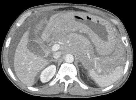 Case 5: Mesenteric Biopsy Axial CT of the abdomen (left)