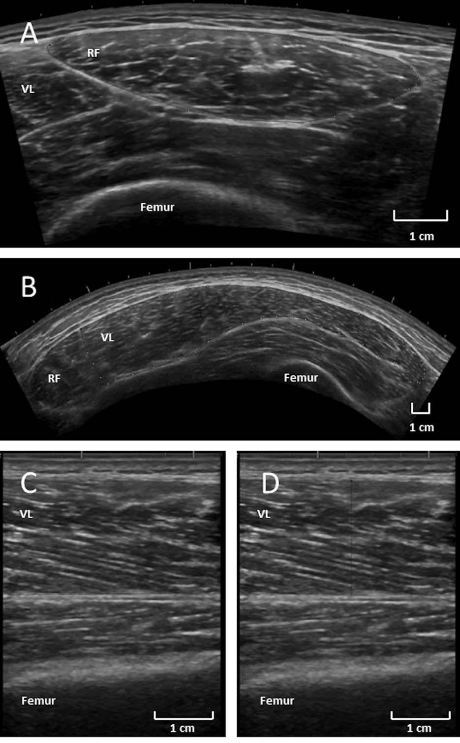 FIGURE 2. Example of ultrasound measurements of rectus femoris (RF) cross-sectional area (A), vastus lateralis (VL) cross-sectional area (B), VL pennation angle (C), and VL muscle thickness (D).