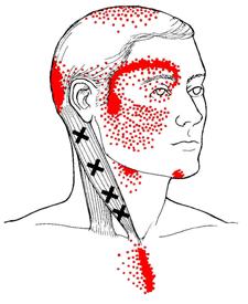 According to her research, a practitioner could look and scan the body for active trigger points (knots) and re- create the client s pain pattern when pressed.
