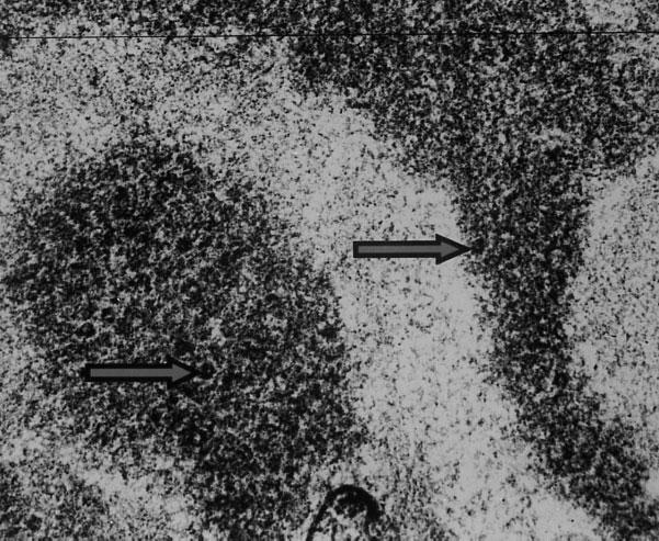 1928 A. A. Sabry et al. Fig. 4. Electron microscopy for HCV-positive patient showing virus-like particles inside electron-dense deposits (56 nm) with higher magnification. Table 2.