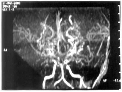 Fig. 2. MRA 6 months postoperative improved cerebral blood flow. 3. Hasuo K, Mihara F, Matsushima T. MRI and MR angiography in Moya Moya disease. J Magn Reson Imaging 1998; 8: 762-766. 4.