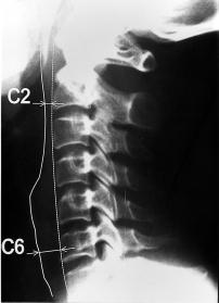 152 Cervical Spine Prevertebral Soft Tissue Thickness in Chinese RESULTS The range, mean and standard deviation of all measurements were listed in Table 1.