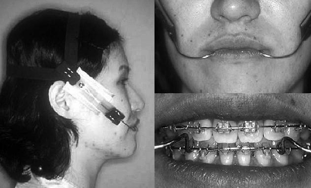 CLASS III TREATMENT USING J-HOOK HEADGEAR TO MANDIBLE 337 uprighted, second premolars leveled, and canines retracted.