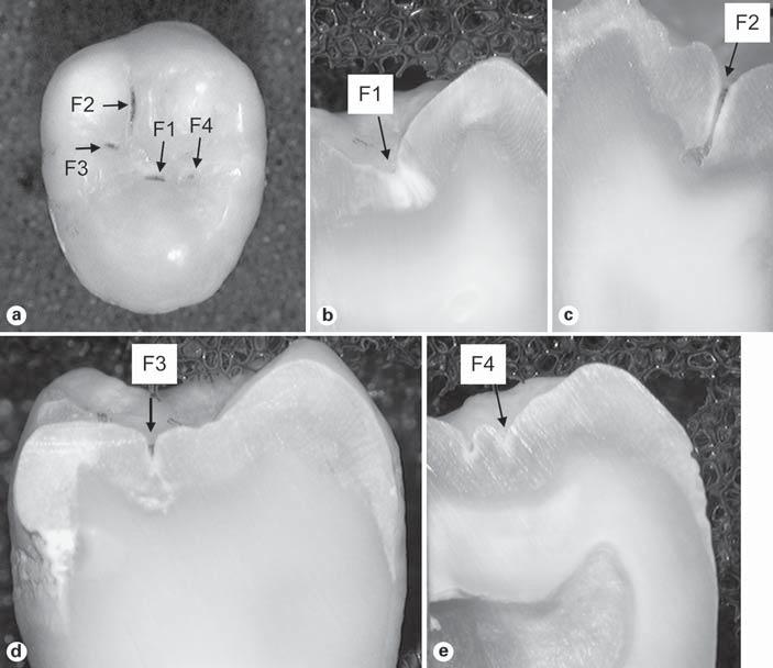 Fig. 4. A carious tooth sample and its PTR and LUM signals using 659 nm excitation.